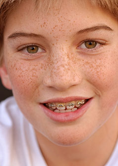 life with braces