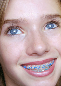 types of braces
